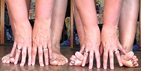 Image of toes and fingers